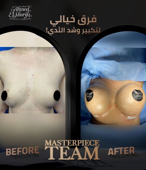 تجارب ناجحة لتكبير الثدي
